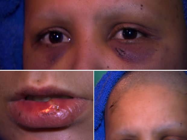 Marcas das agressões que a mulher afirma ter sofrido do marido (Foto: Reprodução/TV Globo)